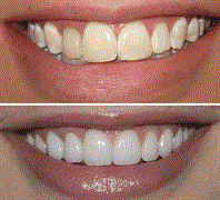 beauty hair removal teeth - 2